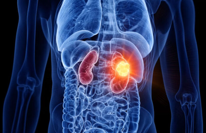 Telix and Grand Pharma Launch ZIRCON-CP Phase III Trial of TLX250-CDx for Kidney Cancer in China